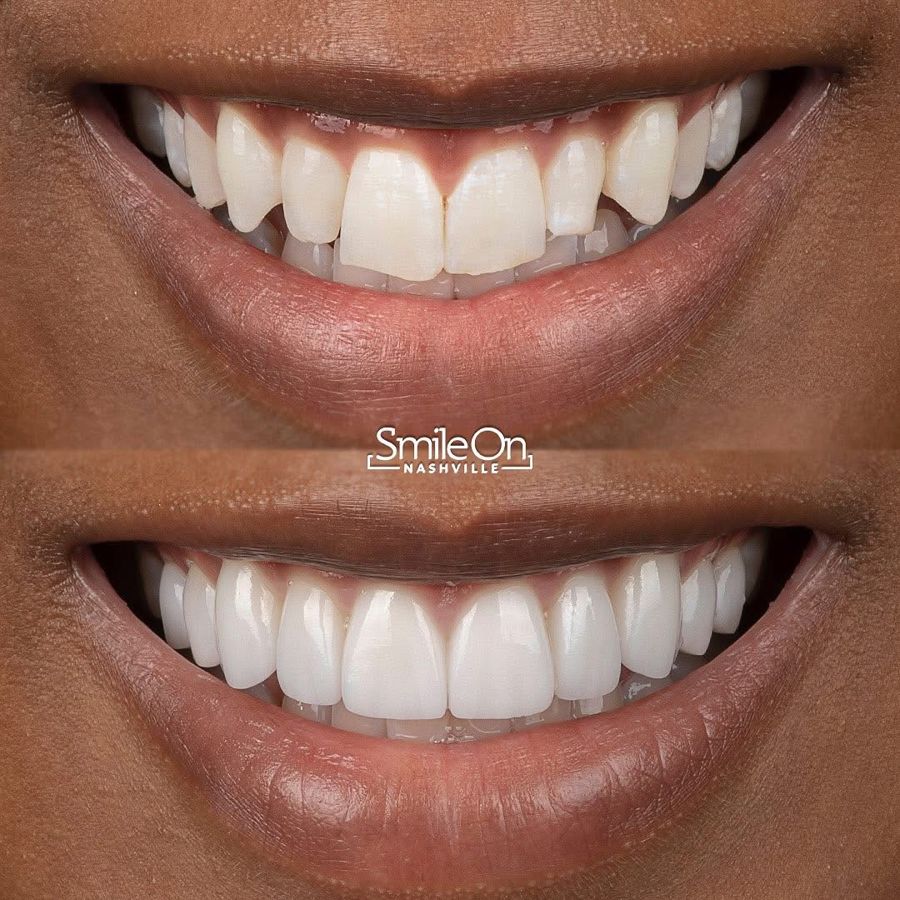 Before and after of a patient's smile, before on top and after on the bottom
