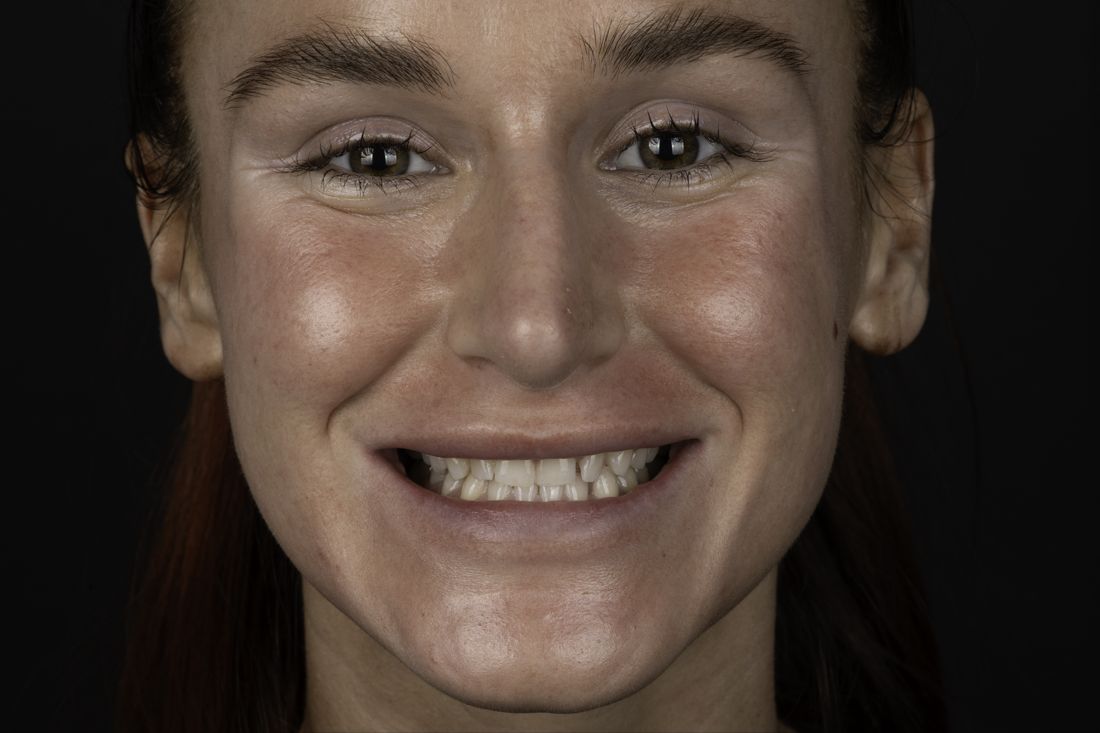 Patient smile before treatment