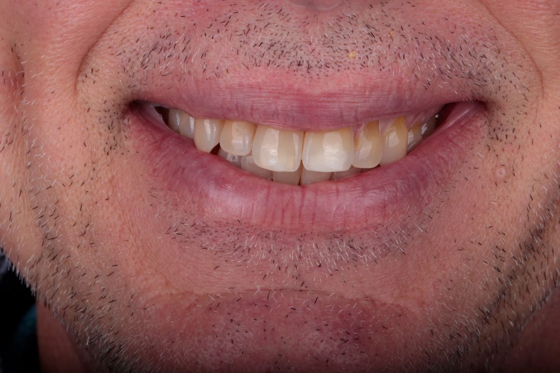 Patient smile before treatment