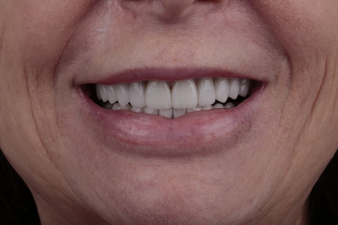 The same patient's smile after treatment