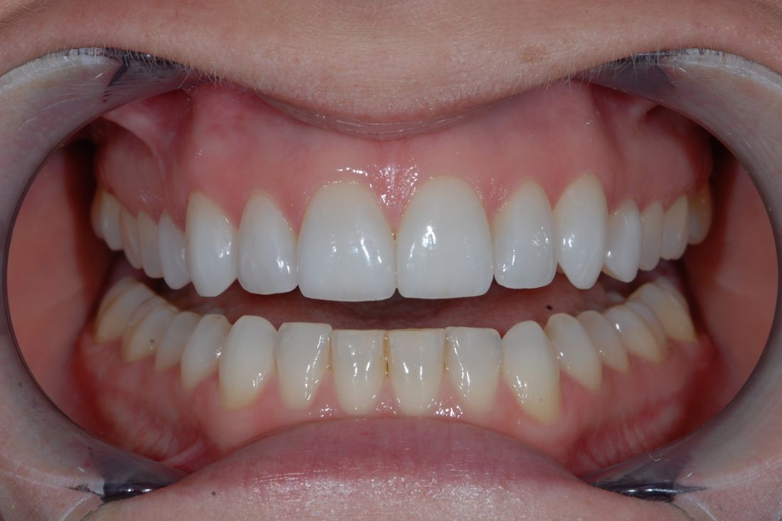 The same patient's smile after treatment