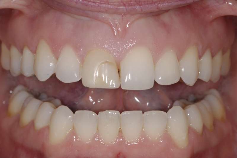Patient smile before treatment